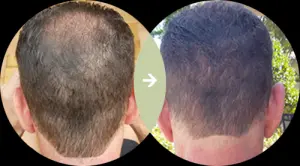 Male Hair Restoration Results